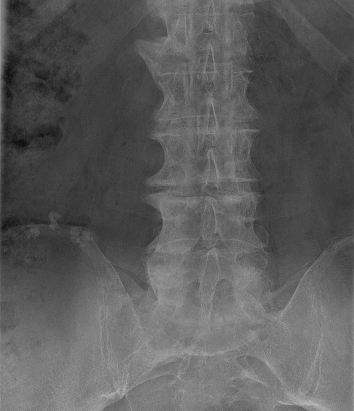 DISH Lumbar Vertebra